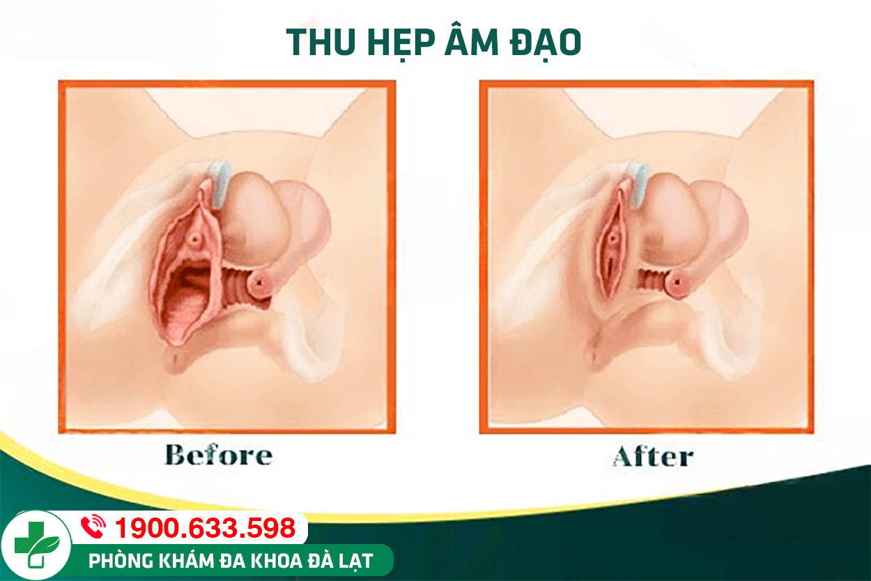 Hình ảnh minh họa